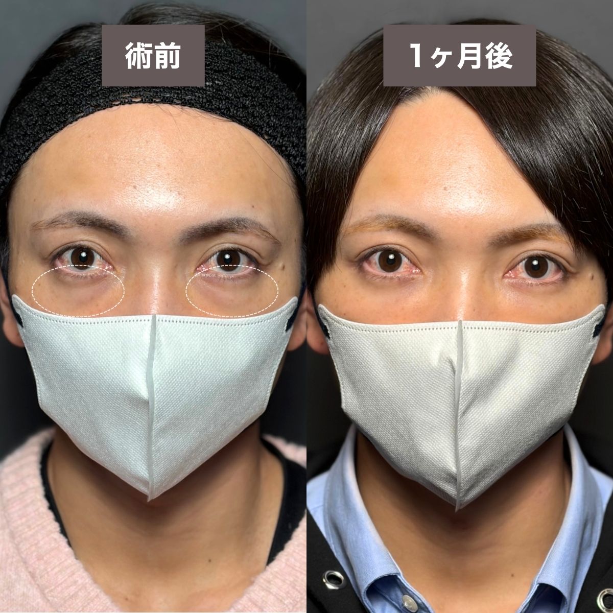症例2：切らない目の下の膨らみとり＋脂肪注入