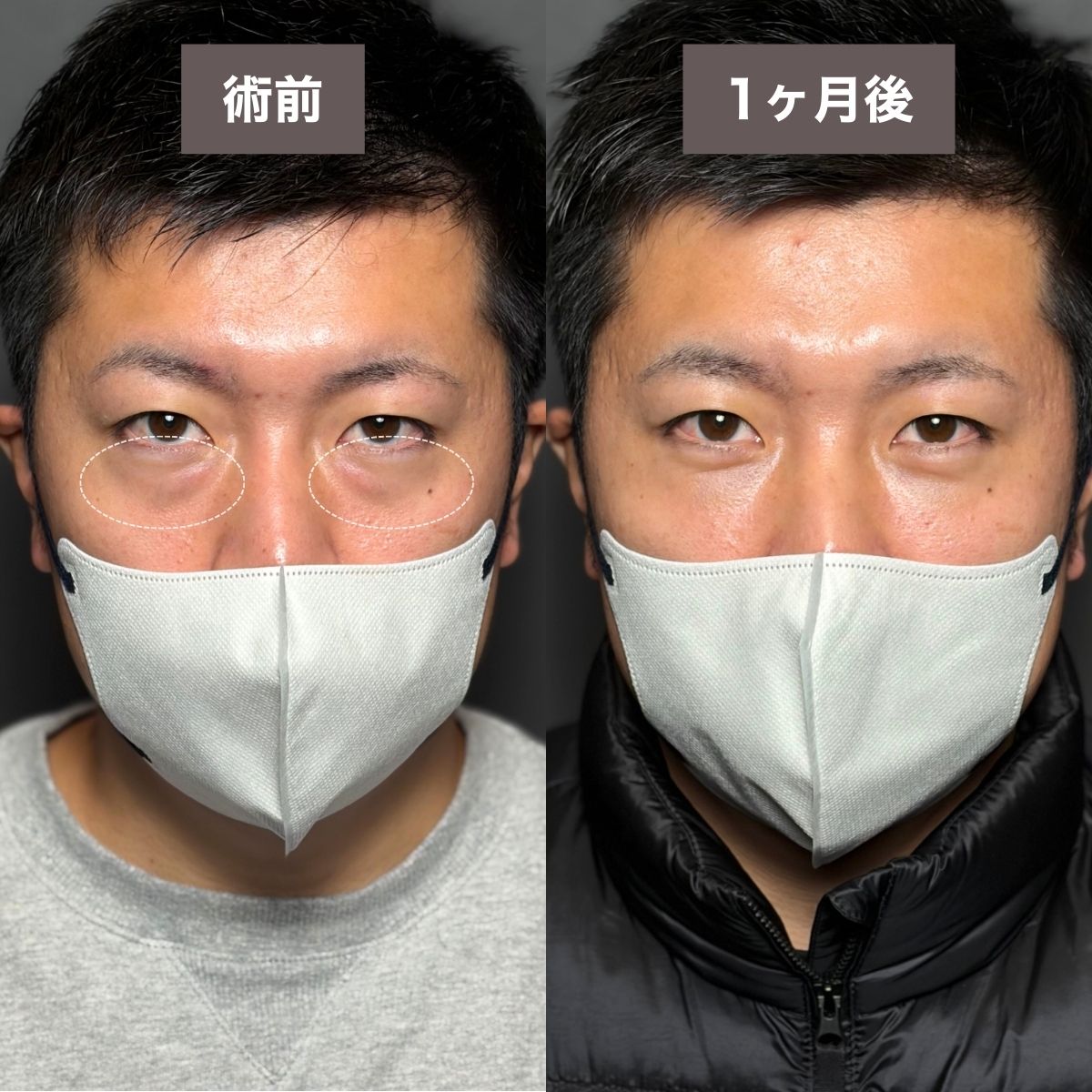 症例3：裏ハムラ法