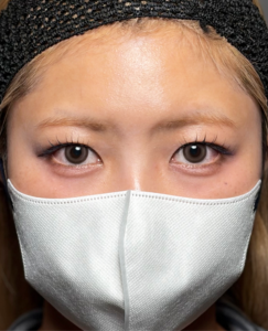 二重埋没法　施術後1週間一例