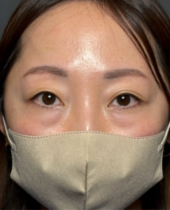 裏ハムラ　施術後1ヶ月一例