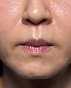 人中短縮プレミアム　口角挙上　施術後1週間一例
