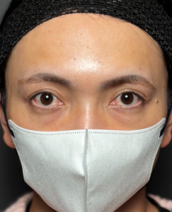 裏ハムラ　施術後1週間一例