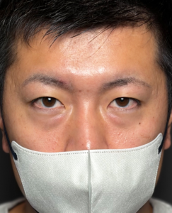 裏ハムラ　施術後1週間一例