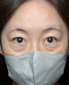 切らない目の下の膨らみとり+ヒアルロン酸注入　施術後1週間一例