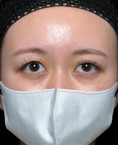 二重埋没法　目の上脱脂　施術後1週間一例