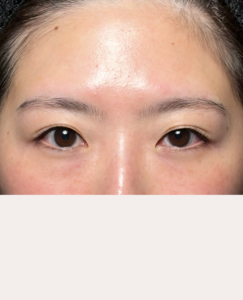 クマ取り／二重埋没法他院修正　目元の複合施術後2週間後一例