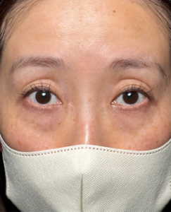 クマ取り　二重埋没法　脂肪注入　目元の複合施術後1ヶ月一例