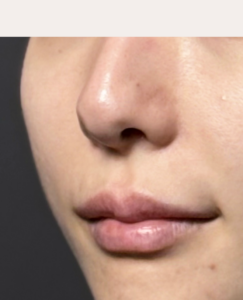 人中短縮プレミアム　施術後1週間一例