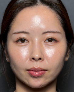 脂肪吸引　施術後2ヶ月一例