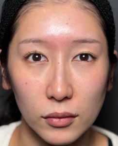 脂肪注入　施術後1ヶ月一例