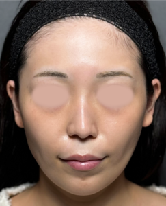 脂肪注入　【施術後1ヶ月一例】