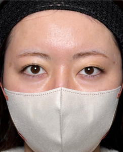 二重埋没法　【施術後1週間一例】