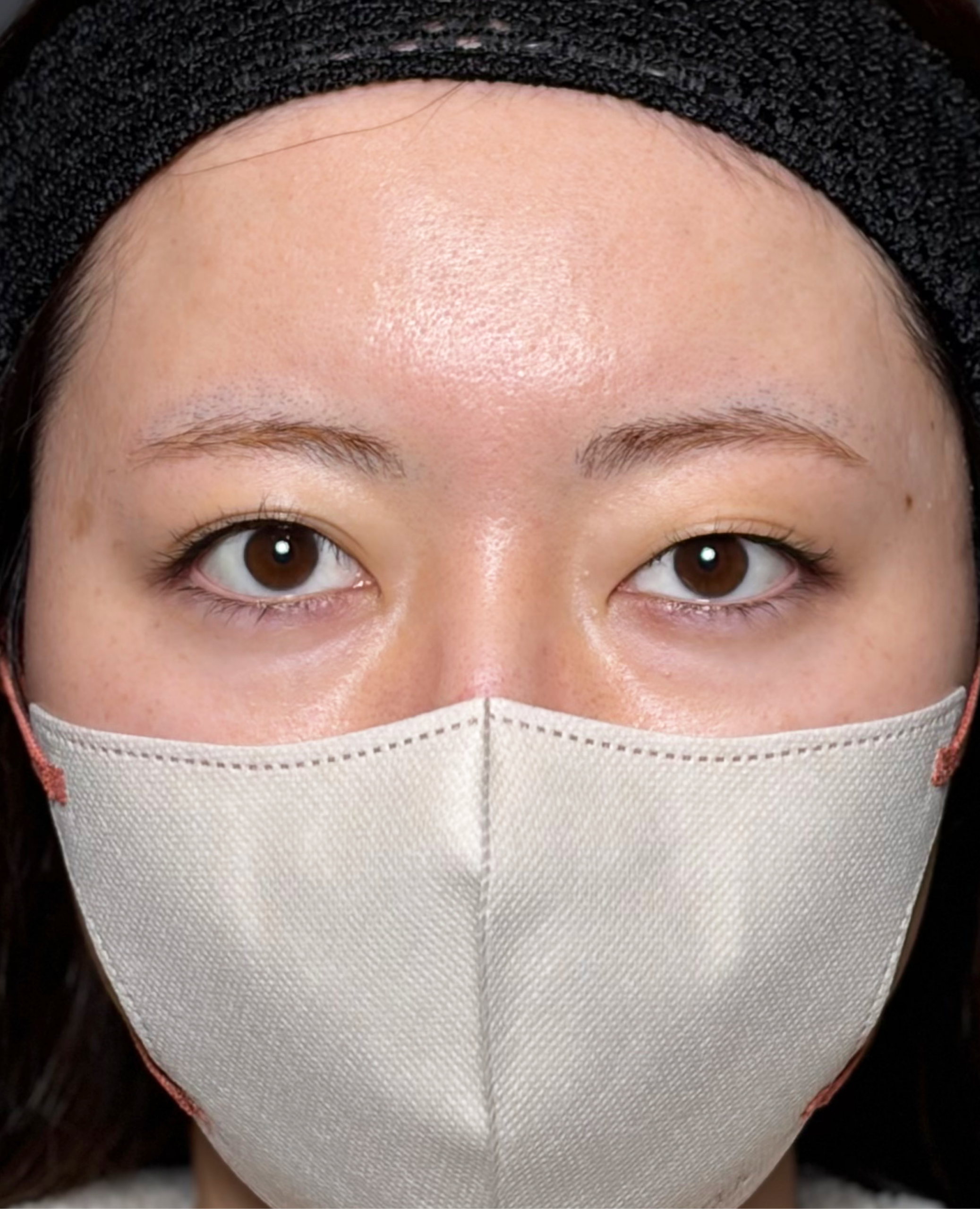 二重埋没法　【施術後1ヶ月一例】