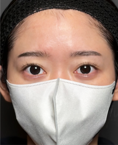 二重全切開　【施術後1ヶ月一例】