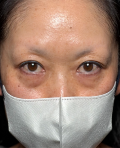 表ハムラ／ヒアルロン酸／糸リフト　【施術後1ヶ月一例】