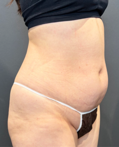 腹部脂肪吸引　【施術後1ヶ月後一例】