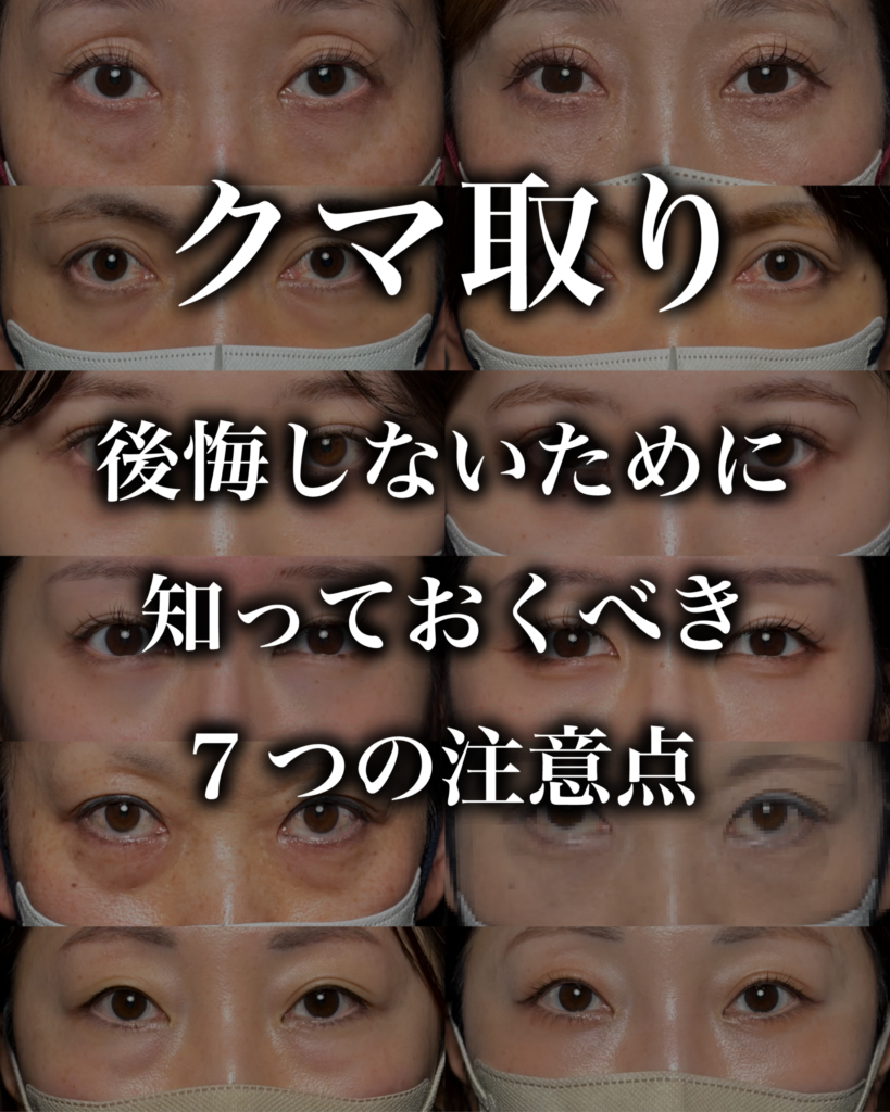 クマ取り手術の落とし穴｜後悔しないために知っておくべき7つの注意点