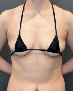 脂肪注入豊胸 3Dプレミアム注入 LSSAオプション　【施術後1ヶ月一例】