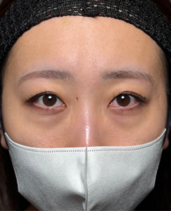 裏ハムラ／二重埋没法／目の上脱脂／全顔脂肪注入　【施術1週間後一例】