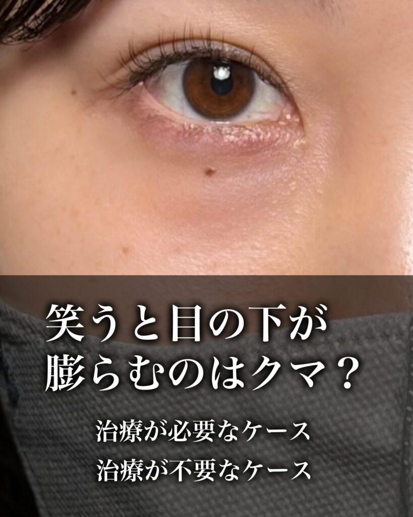 笑うと目の下が膨らむのはクマ？治療が必要なケース、不要なケース