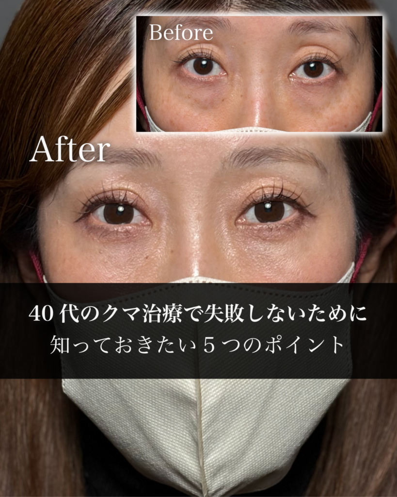 40代のクマ治療で失敗しないために知っておきたい5つのポイント｜美容治療の正しい選び方