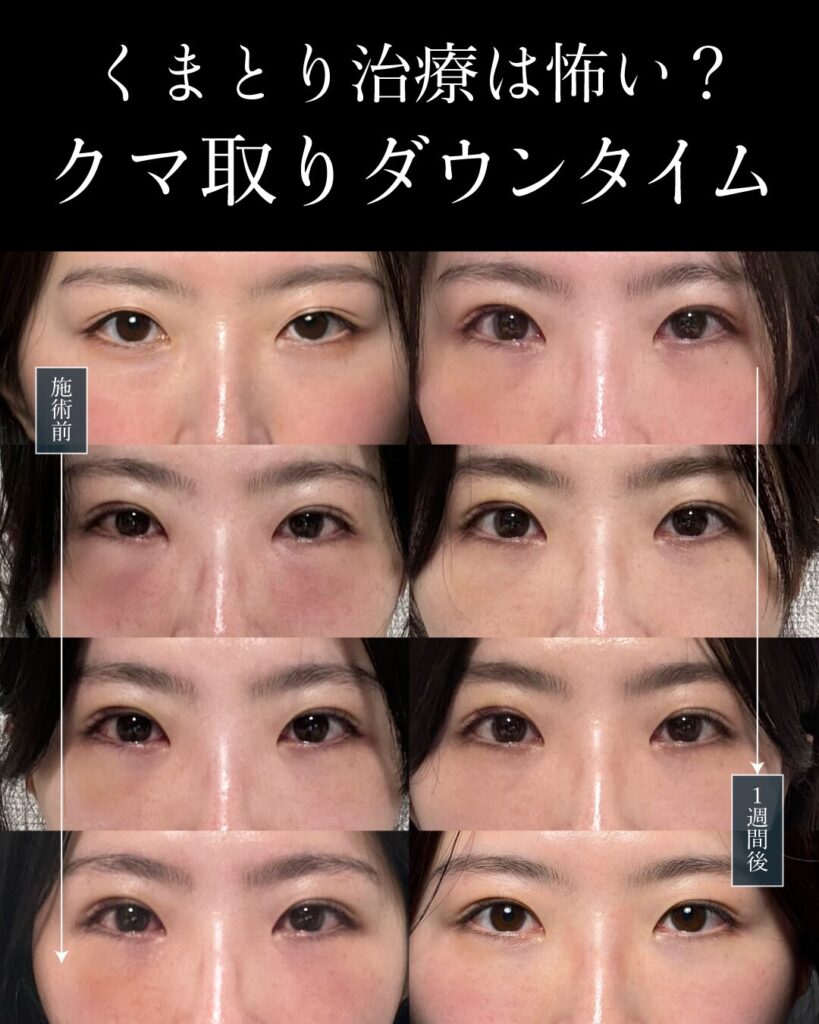 くまとり治療は怖い？本当のダウンタイム