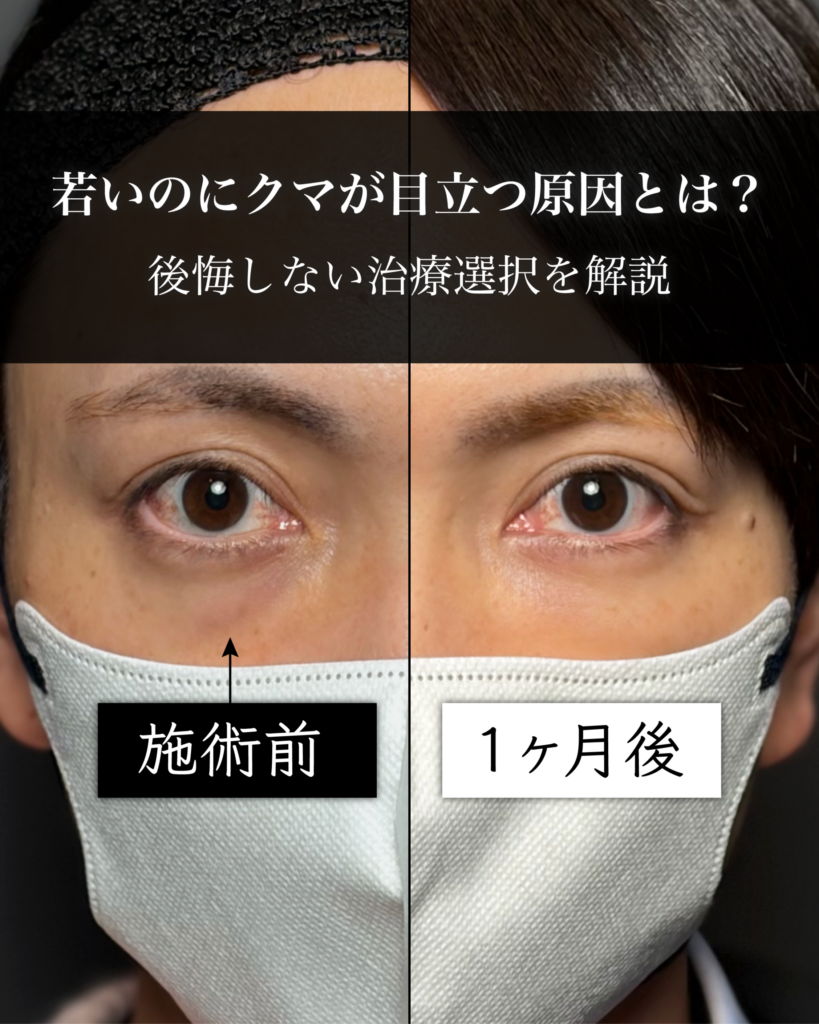 若いのにクマが目立つ原因とは？後悔しない治療選択を解説