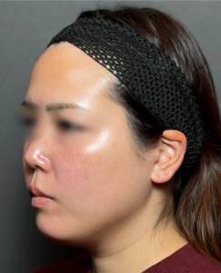 脂肪吸引　【施術後1ヶ月一例】