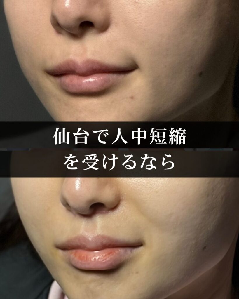 仙台で人中短縮（リップリフト）を受けるなら