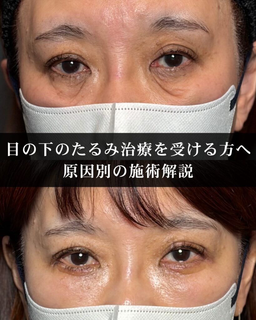 仙台で目の下のたるみ治療を受ける前に。原因別に適した施術を解説