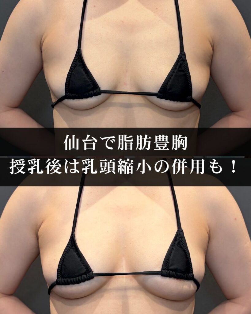 仙台で脂肪豊胸を受けるなら。授乳後は乳頭縮小の併用もおすすめ