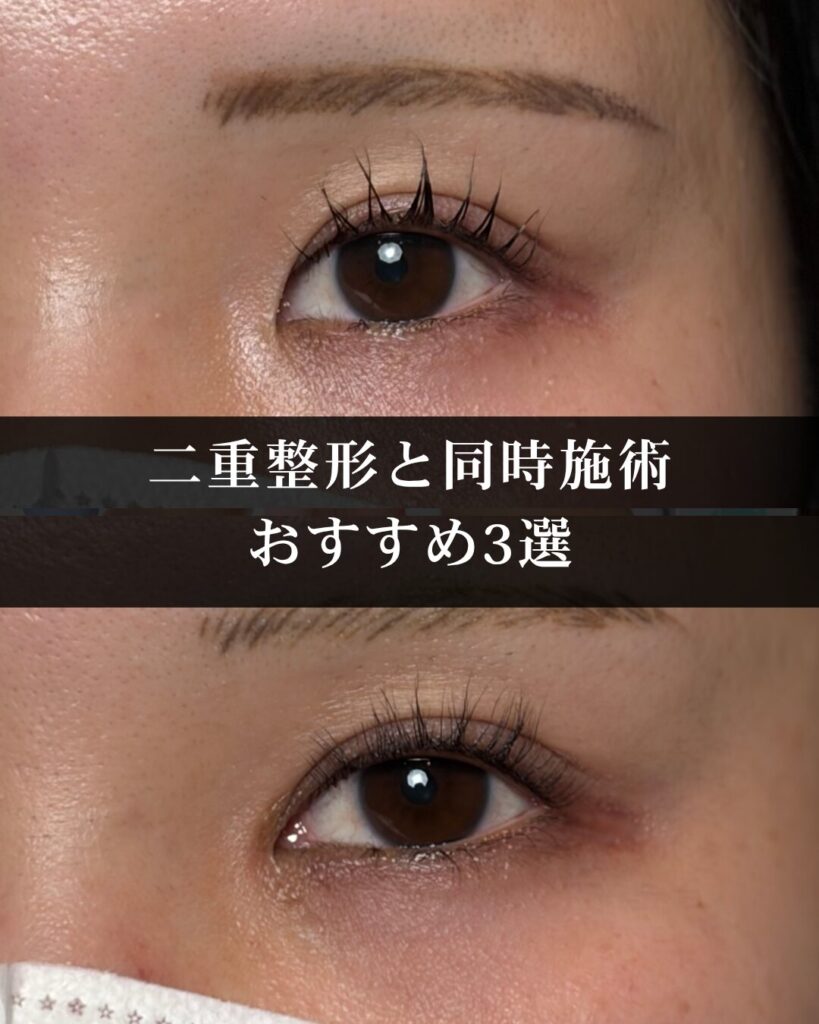 二重整形の時に合わせてやると印象が良くなる施術3選を仙台の美容外科医が解説