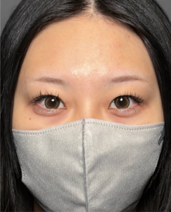 眉下切開　【施術後3ヶ月】