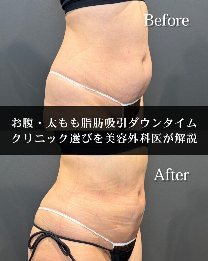 仙台で脂肪吸引を受けるなら？お腹・太もものダウンタイムとクリニック選びを美容外科医が解説