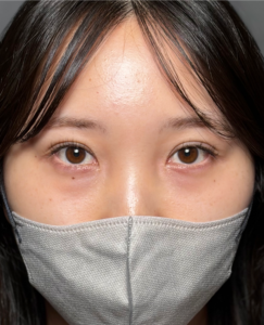 裏ハムラ　施術後1ヶ月一例