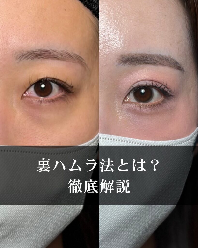 裏ハムラ法とは？くまとり治療の最前線を徹底解説