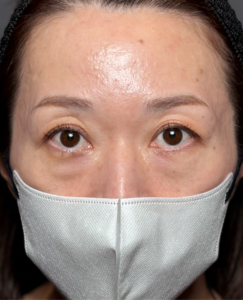 裏ハムラ　施術後1ヶ月一例