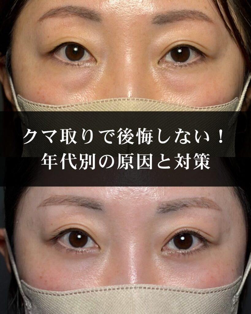 クマ取りで後悔しない！年代別の原因と対策、クリニック選びの重要ポイント