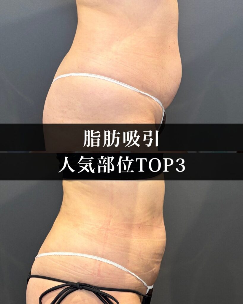 レクリ仙台で脂肪吸引の人気部位TOP3