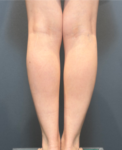 下腿脂肪吸引　【施術後1ヶ月後一例】