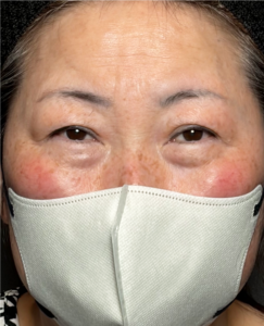 裏ハムラ　施術後3ヶ月一例