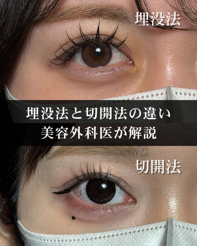 仙台で二重整形を受けるなら？埋没法と切開法の違いを美容外科医が解説