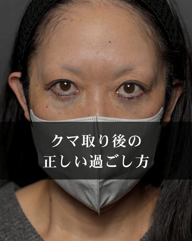 クマ取り後のダウンタイムを乗り越える！過ごし方・施術の種類・クリニック選びまで徹底解説