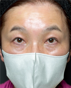 裏ハムラ　施術後3ヶ月一例