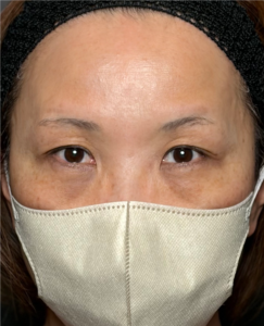 切開ハムラ　施術後1ヶ月一例