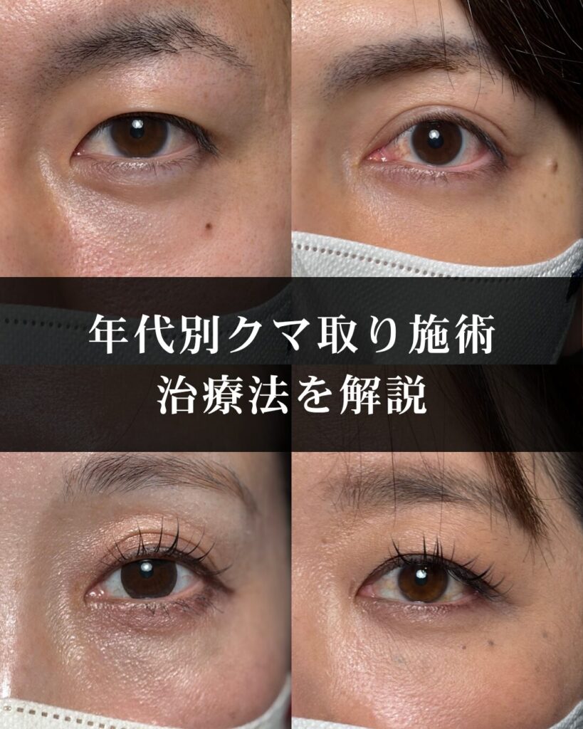 年代別クマ取り施術｜最適なタイミングと治療法を解説