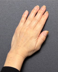 手の甲　脂肪注入　【施術後1ヶ月一例】