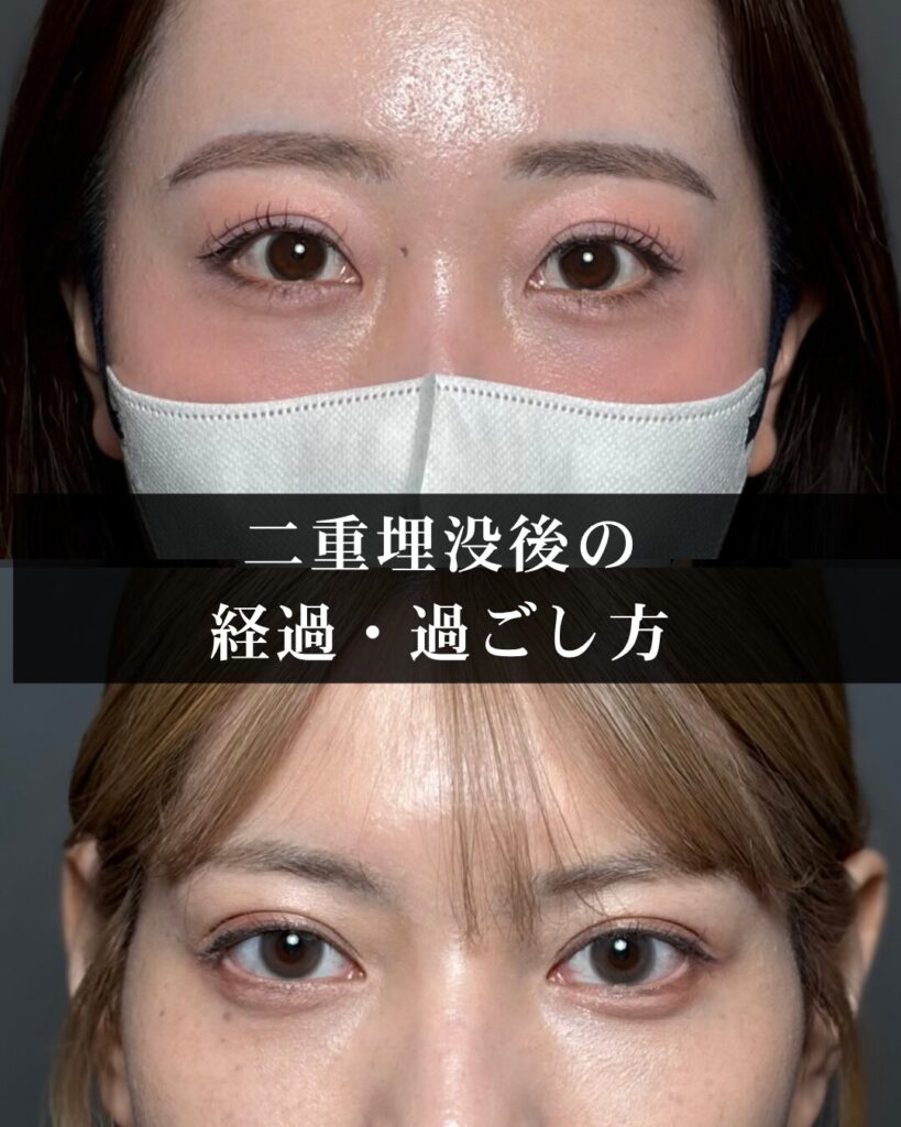 仙台で二重整形の名医が解説。二重埋没後の経過・過ごし方