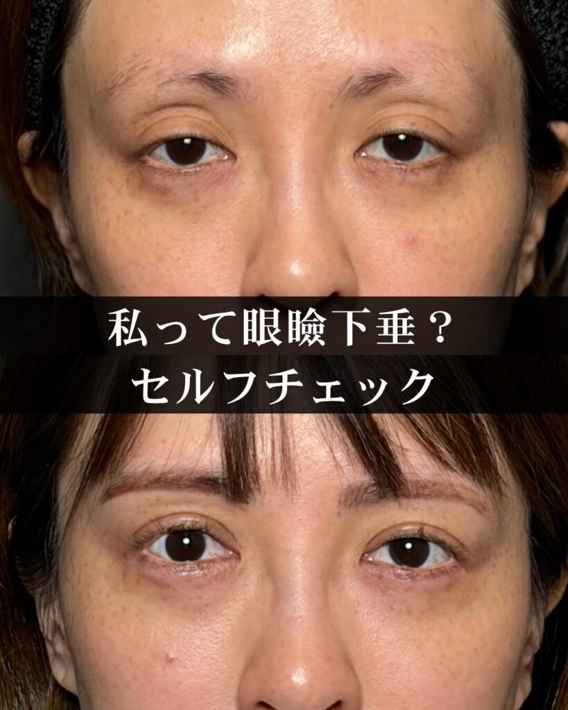私って眼瞼下垂？眼瞼下垂と偽性眼瞼下垂について解説