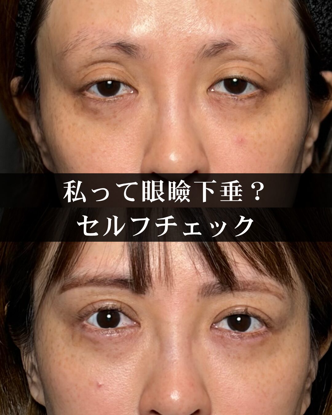 眼瞼 下垂 チェック